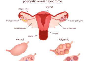 Can Homeopathy Help PCOS?